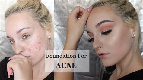 foundation that covers acne scars.